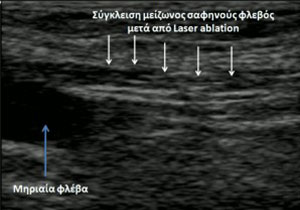 κιρσοί λειζερ