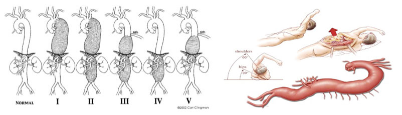 Θωρακοκοιλιακό ανεύρυσμα