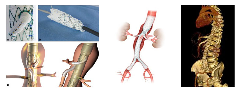 Θωρακοκοιλιακό ανεύρυσμα