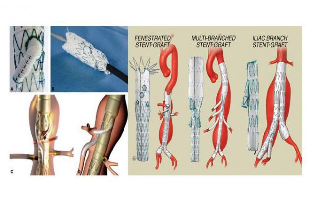 thorakokoiliako-aneyrisma1