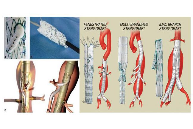 thorakokoiliako-aneyrisma1