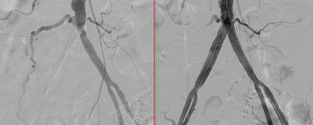 απόφραξη λαγονίων αρτηριών