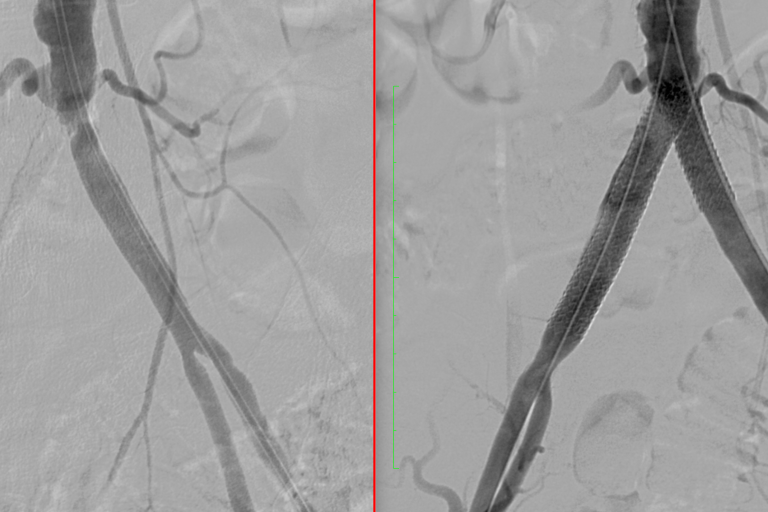 απόφραξη λαγονίων αρτηριών