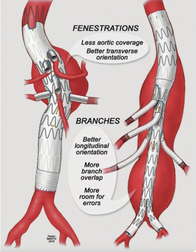 FEN-BRANCH DIFFER