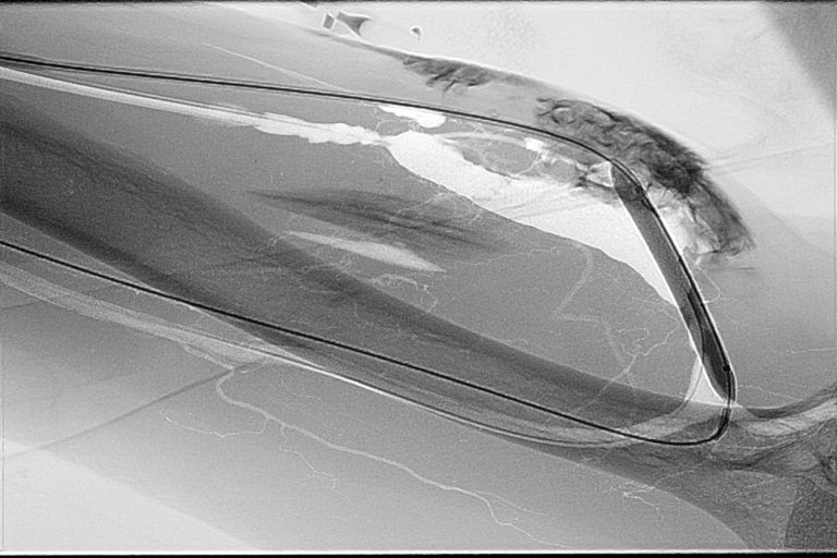 Fluoroscopy2 Αγγειοπλαστική σε φιστουλα για αιμοκάθαρση