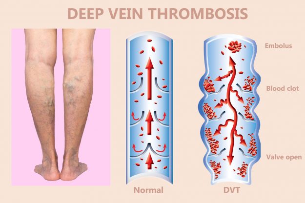 Κιρσοί και Φλεβική Ανεπάρκεια