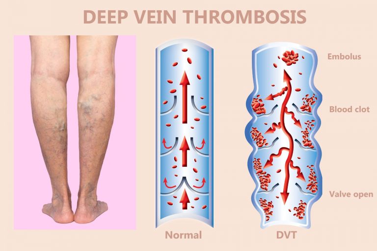 θεραπεία των κιρσών και της φλεβικής ανεπάρκειας Κιρσοί και Φλεβική Ανεπάρκεια